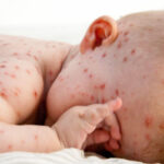 Bệnh thủy đậu ở trẻ em: Dấu hiệu nhận biết và cách điều trị nhanh khỏi nhất